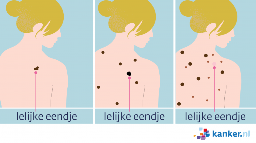 Melanoom als lelijk eendje tussen andere moedervlekken. Let op moedervlekken die er anders uit zien dan de rest.