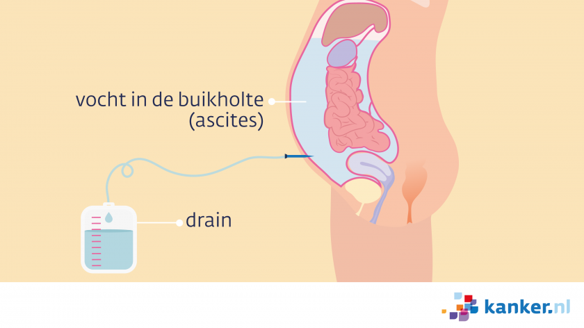 Een ascitesdrain zit via een sneetje in de buikholte. Aan het slangetje (de drain) hangt een zak. Het vocht loopt door het slangetje in de zak.