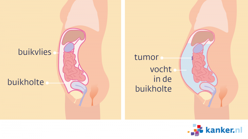 Vocht in de buikholte (ascites) gaat om alle organen heen zitten.