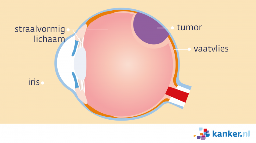 De uvea bestaat uit het straalvormig lichaam, de iris en het vaatvlies.  Een voorbeeld van een uveamelanoom is een tumor in het vaatvlies. 