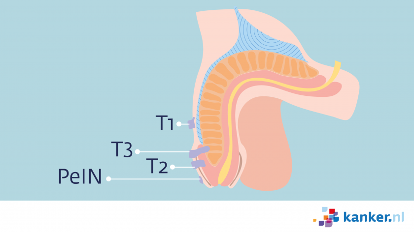 T-indeling peniskanker