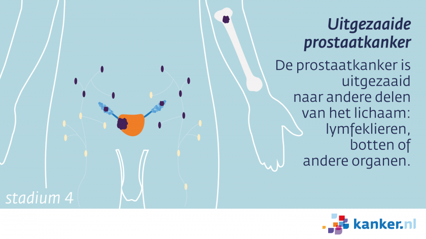uitgezaaide prostaatkanker