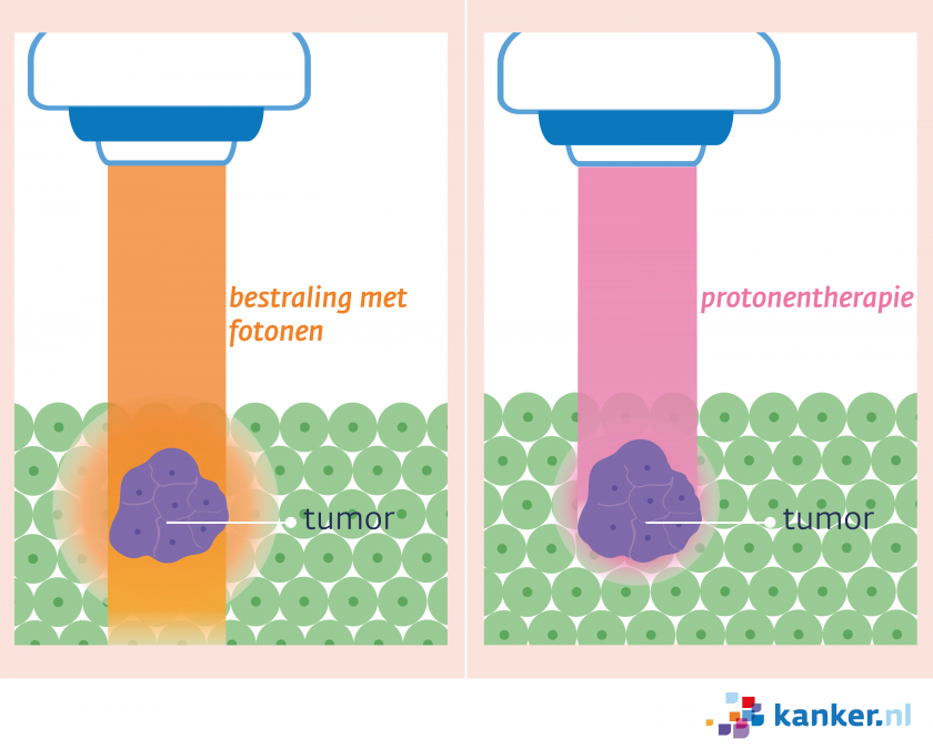 Bij een bestraling met protonen wordt minder omliggend weefsel bestraald dan met een bestraling met fotonen.