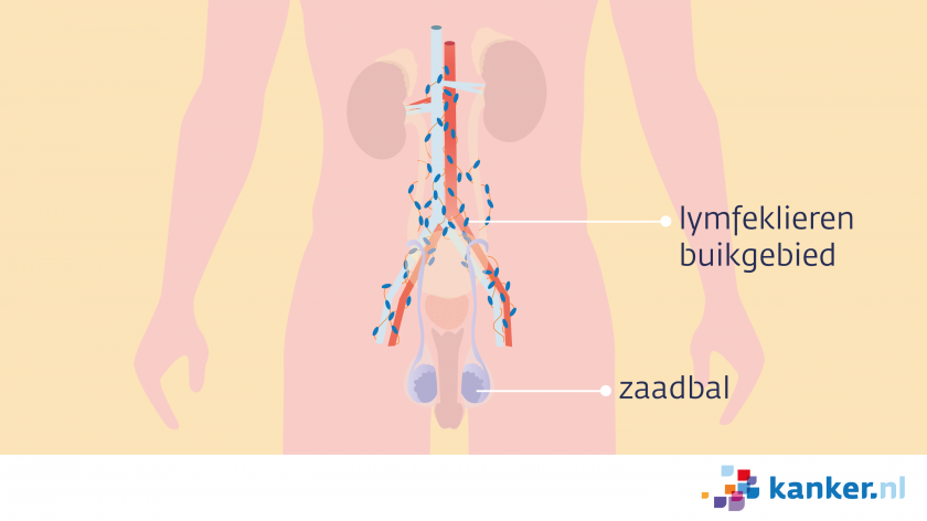 Zaadbalkanker kan uitzaaien naar de lymfeklieren achter in de buik