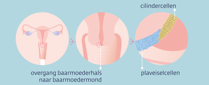 De overgang van de baarmoederhals naar de baarmoedermond. Aan de binnenkant het slijmvlies zitten cilindercellen, aan de buitenkant plaveiselcellen.