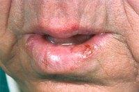 Plaveiselcelcarcinoom op lip