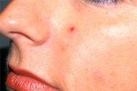 Basaalcelcarcinoom in het gezicht