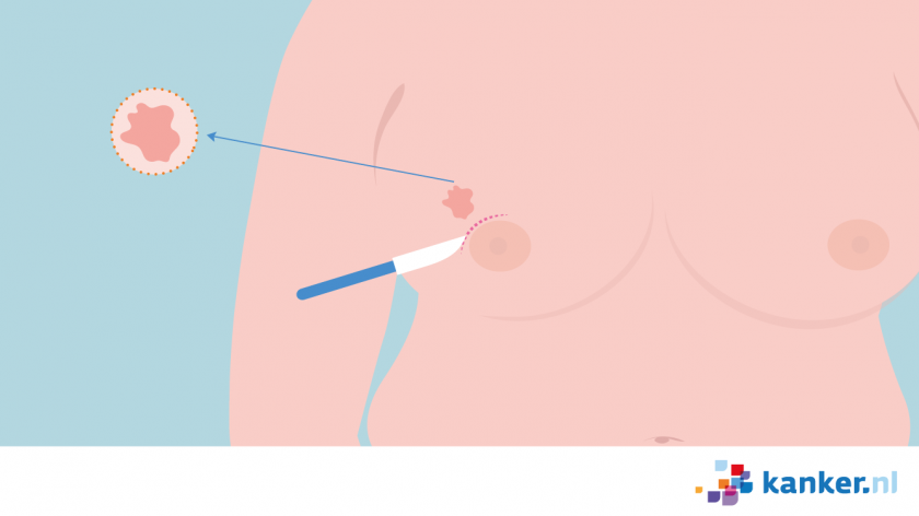 Borstsparende operatie