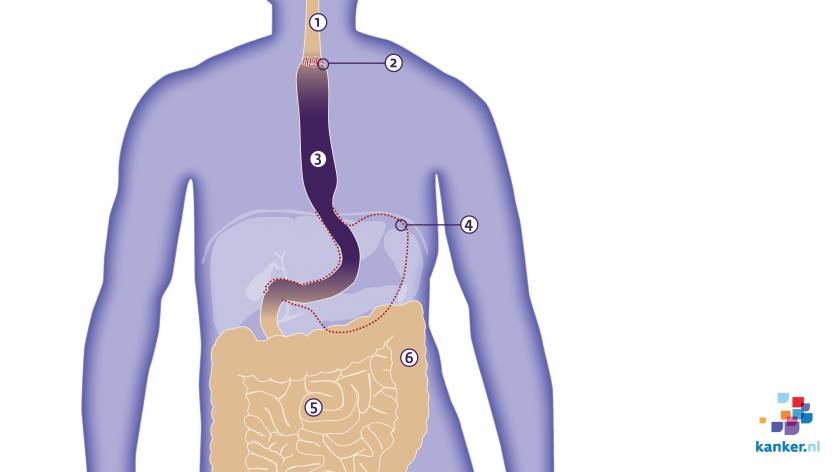 Operatie bij slokdarmkanker / oesofaguscarcinoom / slokdarmcarcinoom
