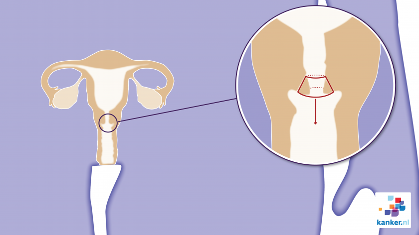 Bij een conisatie verwijdert de gynaecoloog via de vagina een kegelvormig stukje van de baarmoederhals.