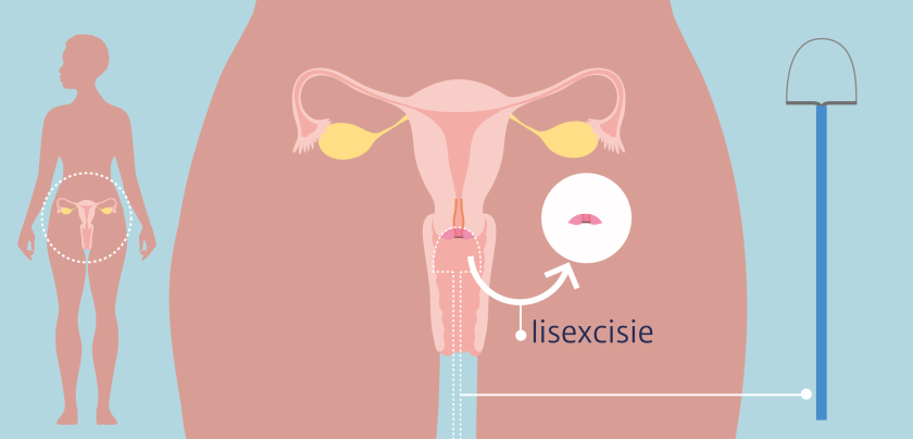Bij een lisexcisie brandt de arts het voorste stukje van je baarmoederhals weg voor onderzoek