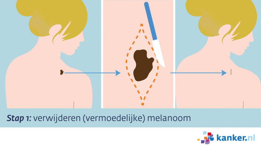 Excisie stap 1 - verwijderen vermoedelijke melanoom