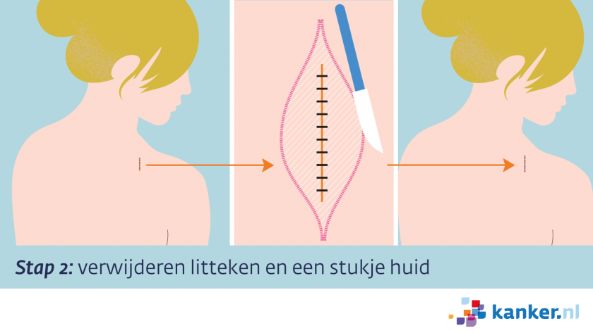 Excisie stap 2 - verwijderen litteken en een stukje huid