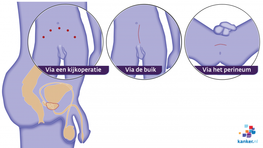 Operatie bij prostaatkanker