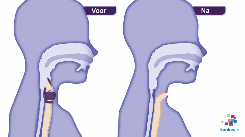 Operatie van het strottenhoofd (totale laryngectomie)