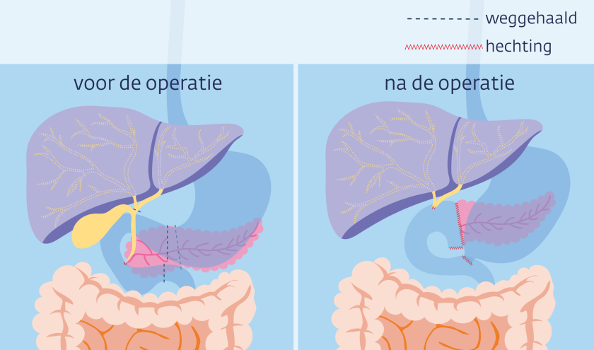 Voor en na situatie van een Whipple-operatie