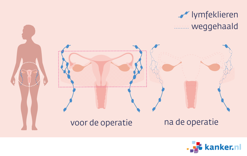 Bij een radicale hysterectomie worden de baarmoeder, de eileiders en de lokale lymfeklieren weggehaald.