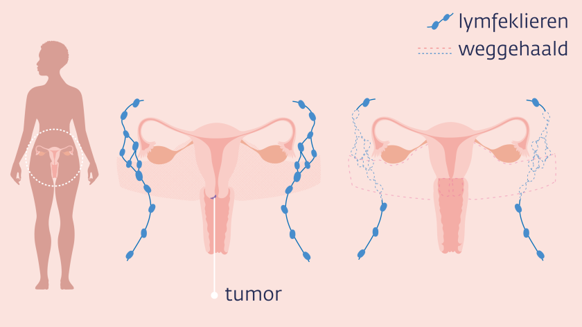 Bij een trachelectomie worden lymfeklieren, de baarmoederhals en het bovenste deel van de vagina weggehaald.