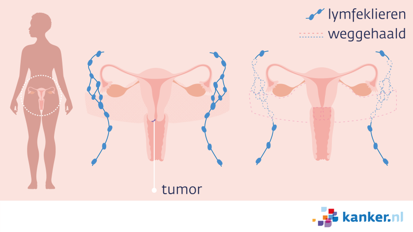 Bij een trachelectomie worden lymfeklieren, de baarmoederhals en het bovenste deel van de vagina weggehaald.