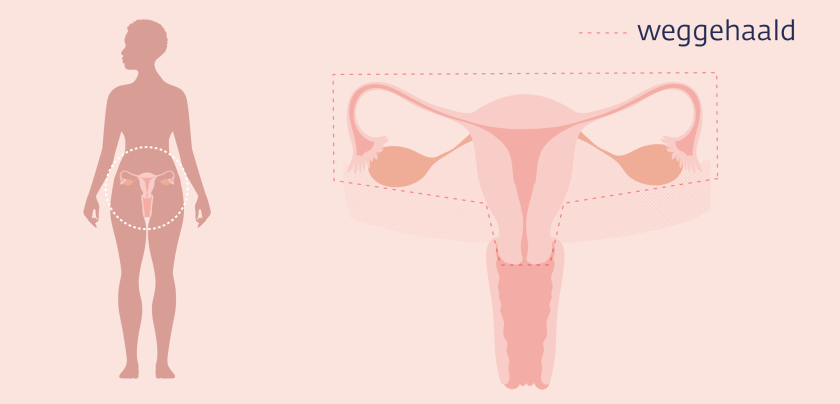 Bij een hysterectomie haalt de arts je baarmoeder en eileiders en vaak ook je eierstokken weg.