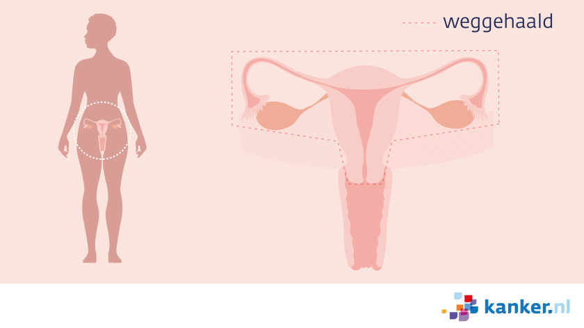 Bij een hysterectomie haalt de arts je baarmoeder en eileiders en vaak ook je eierstokken weg.