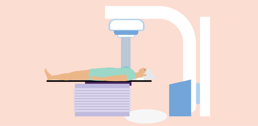 illustratie van een vrouw die op haar rug ligt onder een bestralingstoestel terwijl haar borst wordt bestraald.