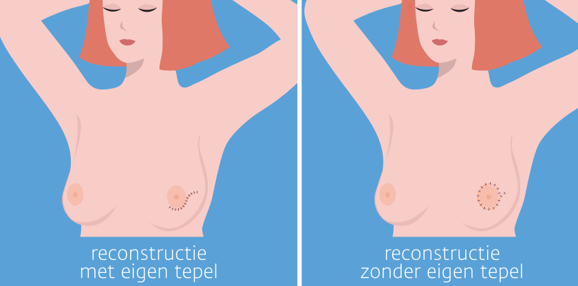 Reconstructie na borstamputatie met en zonder eigen tepel.
