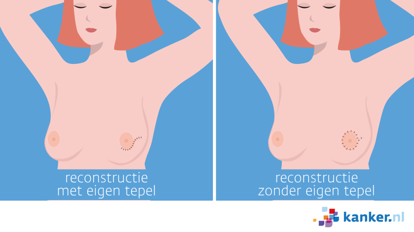 Reconstructie na borstamputatie met en zonder eigen tepel.