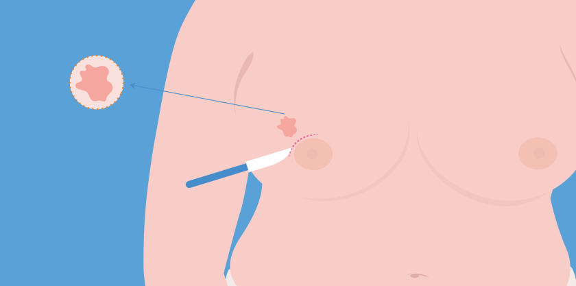 Bij een borstsparende operatie haalt de arts de tumor weg via een snee in je huid.