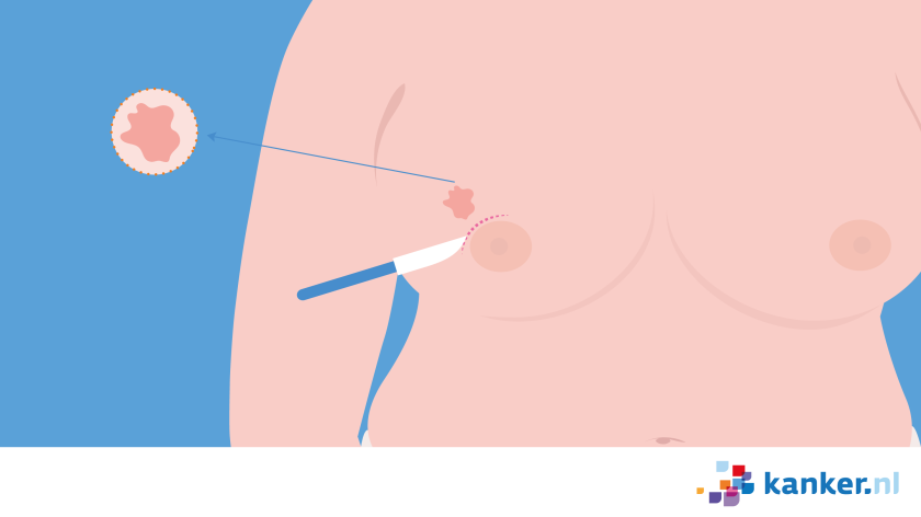 Bij een borstsparende operatie haalt de arts de tumor weg via een snee in je huid.