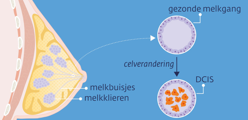 Bij DCIS zitten er kwaadaardige cellen in de melkbuisjes (melkgangen) van de borst.