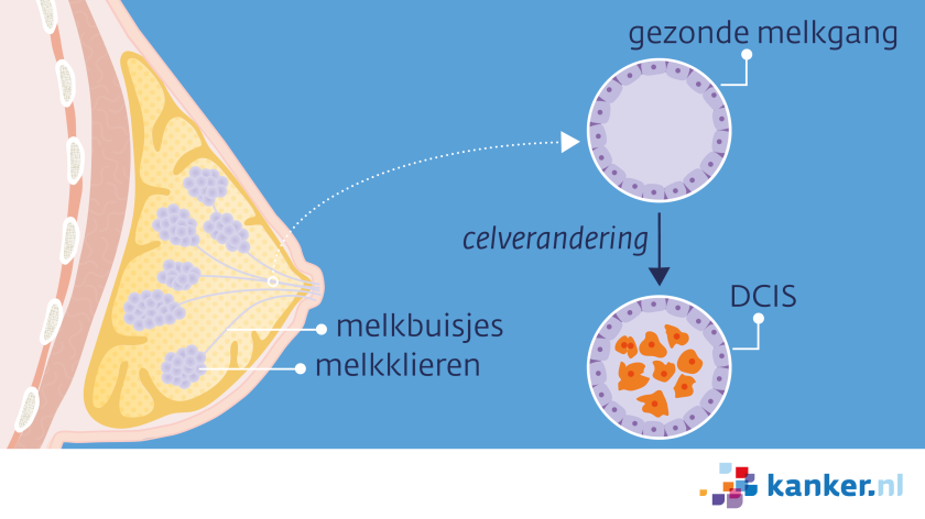 Bij DCIS zitten er kwaadaardige cellen in de melkbuisjes (melkgangen) van de borst.