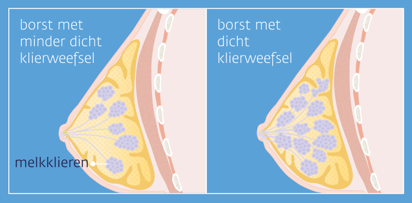 Bij dicht borstklierweefsel zitten er meer melkklieren in de borst dan gemiddeld.
