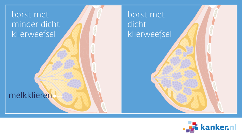 Bij dicht borstklierweefsel zitten er meer melkklieren in de borst dan gemiddeld.