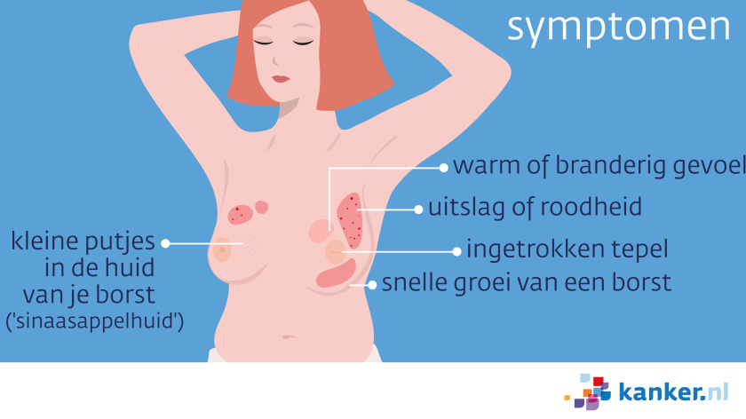Inflammatoire borstkanker kan verschillende vormen hebben, zoals kleine putjes in de huid, uitslag of roodheid, of een ingetrokken tepel.