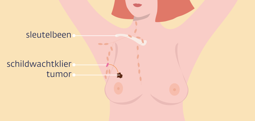 De schildwachtklier kan op meerdere plekken rond de borst zitten.