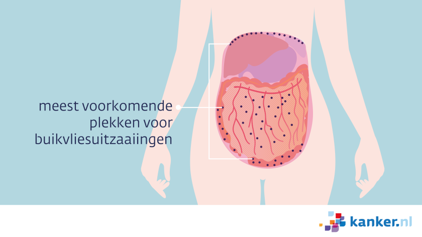 Uitzaaiingen op het buikvlies