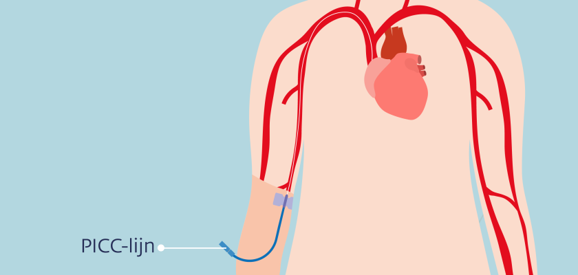 PICC-lijn bij chemotherapie