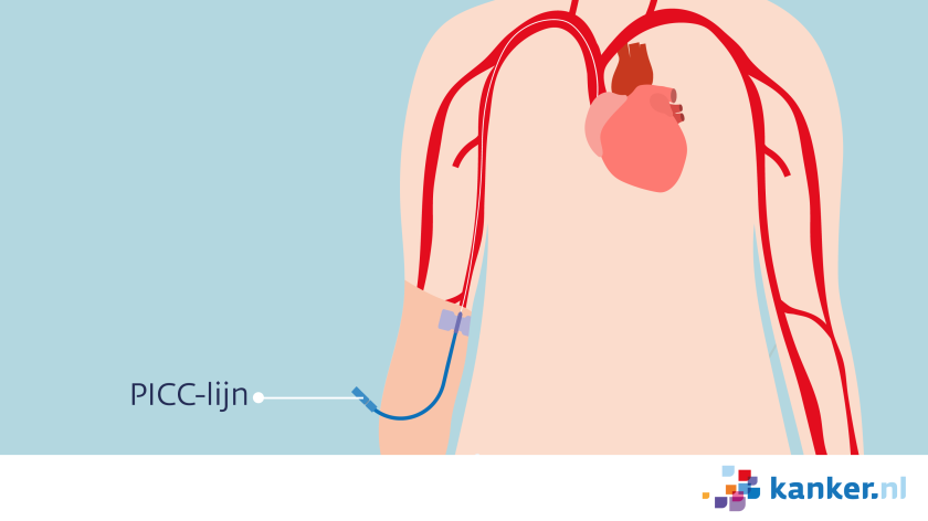 PICC-lijn bij chemotherapie