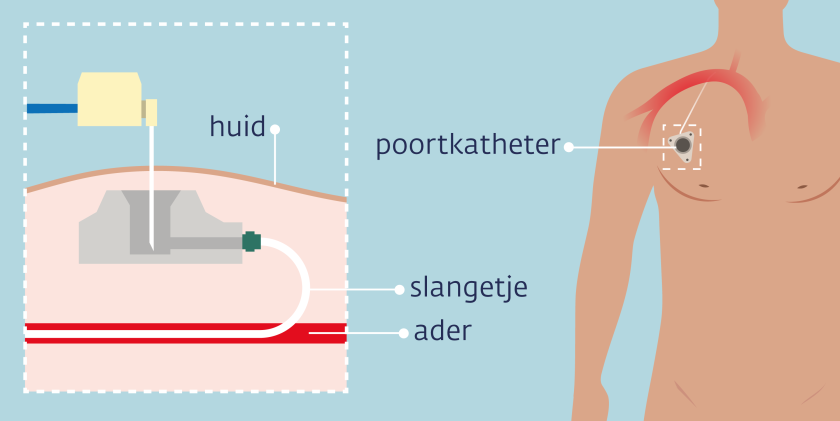 Poortkatheter voor chemotherapie