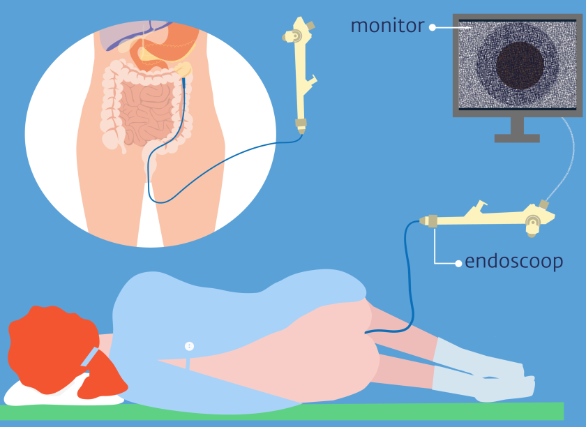 Bij een coloscopie brengt de arts een endoscoop in via de anus
