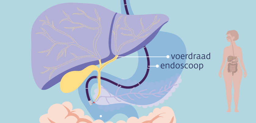 Bij een ERCP-onderzoek schuift de arts een cameraatje aan een flexibele slang in het lichaam.