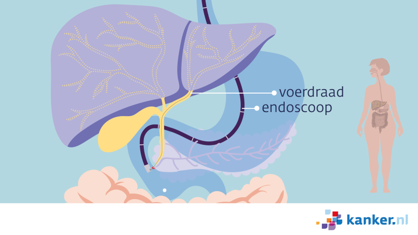 Bij een ERCP-onderzoek schuift de arts een cameraatje aan een flexibele slang in het lichaam.