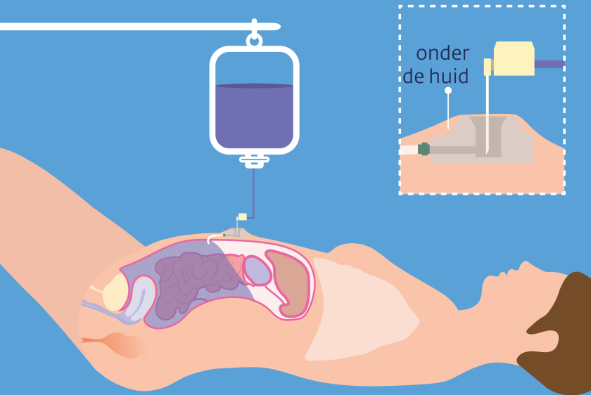 De chemotherapie komt de buik binnen via een kastje onder de huid: de Port-A-Cath.