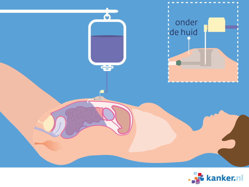 De chemotherapie komt de buik binnen via een kastje onder de huid: de Port-A-Cath.