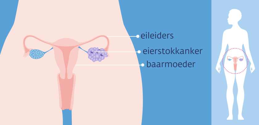 De kankercellen zitten rondom de eierstok
