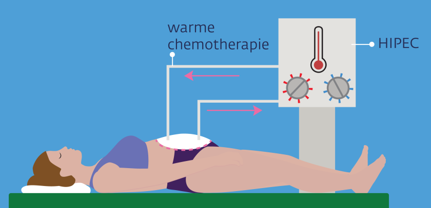 Bij een HIPEC-behandeling wordt er warme chemotherapie door de buikholte gespoeld.