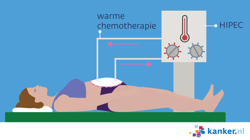 Bij een HIPEC-behandeling wordt er warme chemotherapie door de buikholte gespoeld.