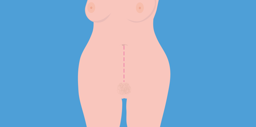 Bij een proeflaparotomie maakt de arts een snee van je schaambeen tot je navel, en soms nog ietsje hoger.