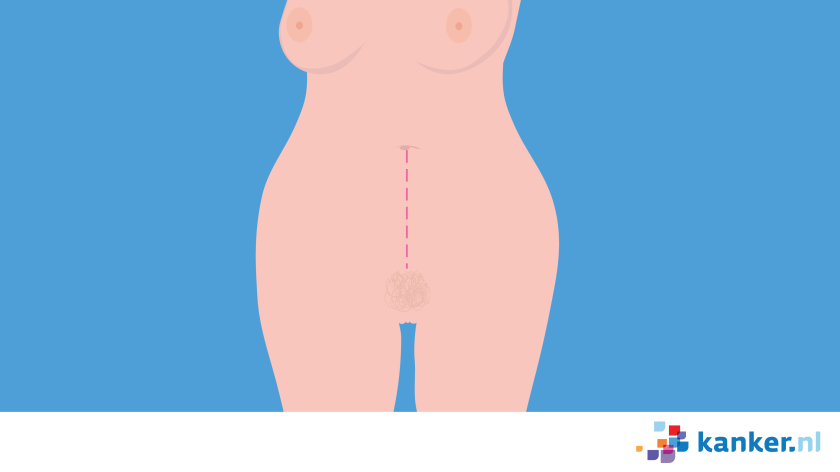 Bij een proeflaparotomie maakt de arts een snee van je schaambeen tot je navel, en soms nog ietsje hoger.